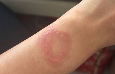 Apple Watch оставили ожог пользователю в рамках обычного использования